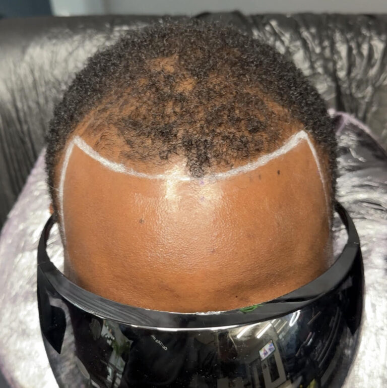Scalp Micropigmentation | Outliers Ink Tattoo Studio Birmingham